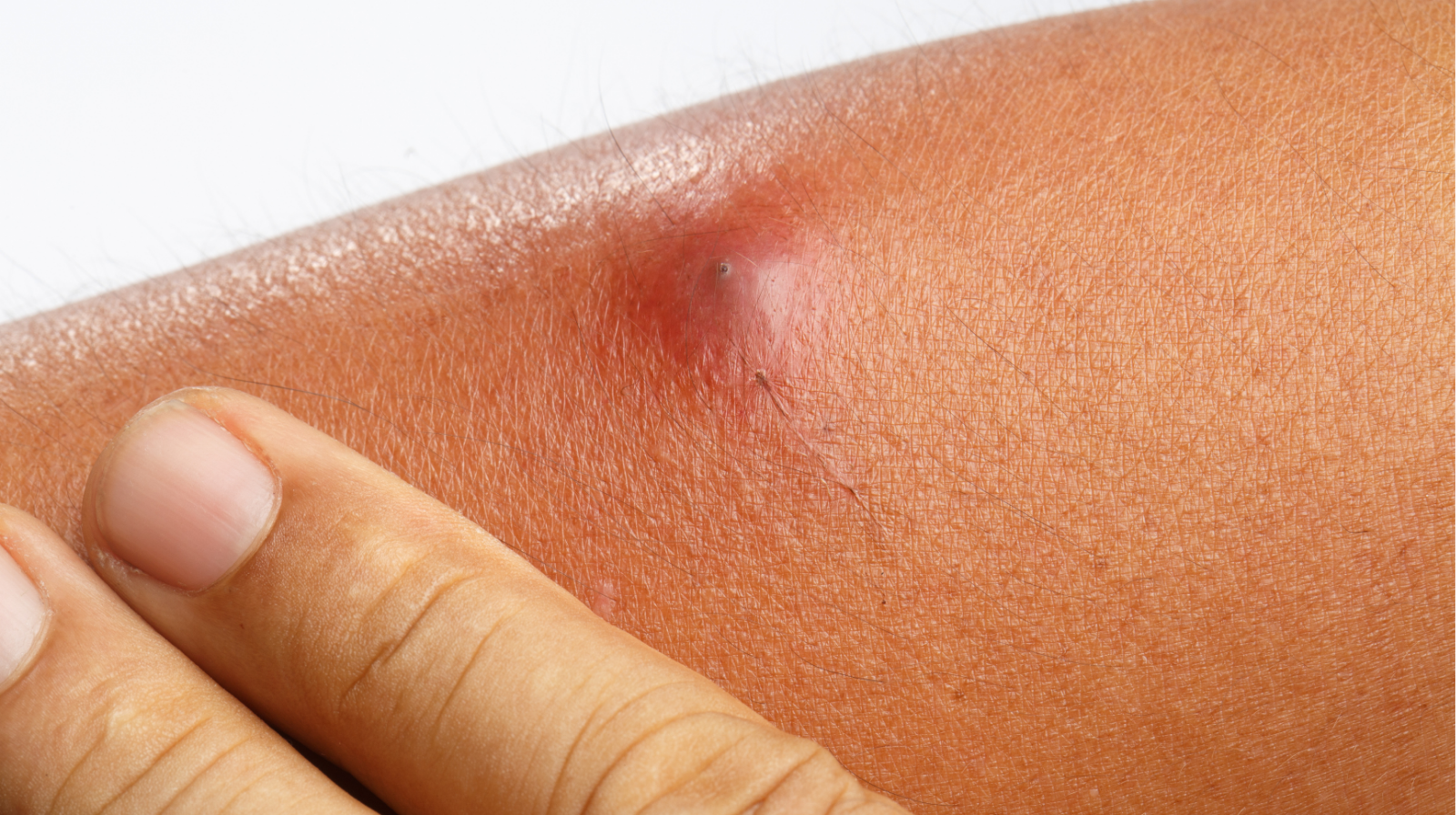 Abscesso: Quando o Corpo Dá Sinais de Alerta