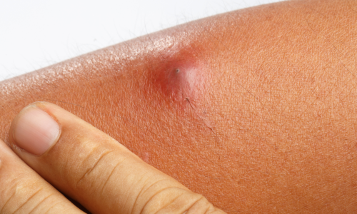 Abscesso: Quando o Corpo Dá Sinais de Alerta