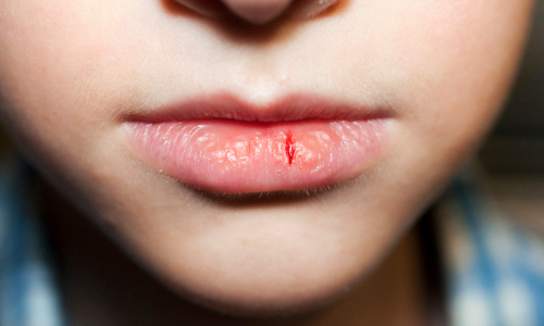 Acordar com a boca seca: o que o corpo pode estar indicando? descrição